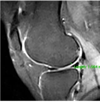 Sagittal MRI before treatment